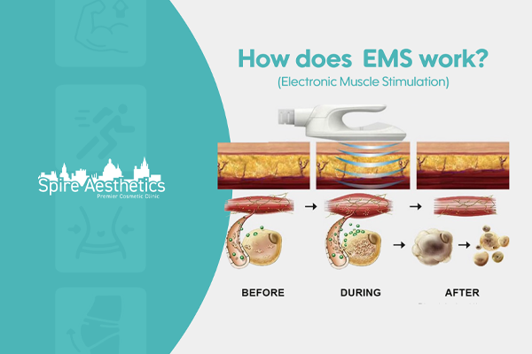 EMS treatment for post pregnancy weight loss treatment Rochford