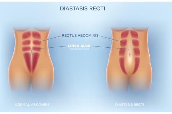 What Non-Surgical Options Are Available for Diastasis Recti Rochford?