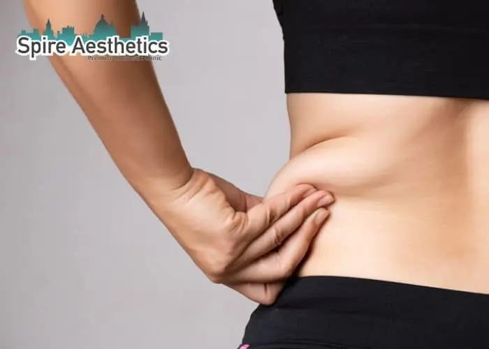 Image of woman pinching fat on their hips Rochford. Fat Freezing treatment