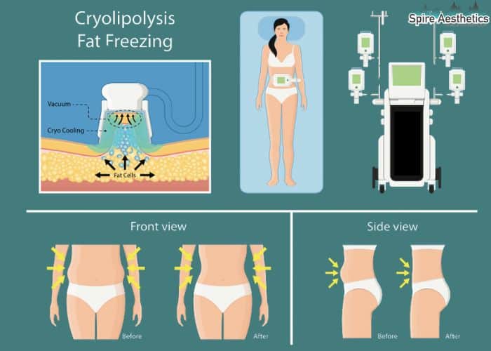 Image of diet and fat freezing combined for best results for Spire Aesthetics Rochford