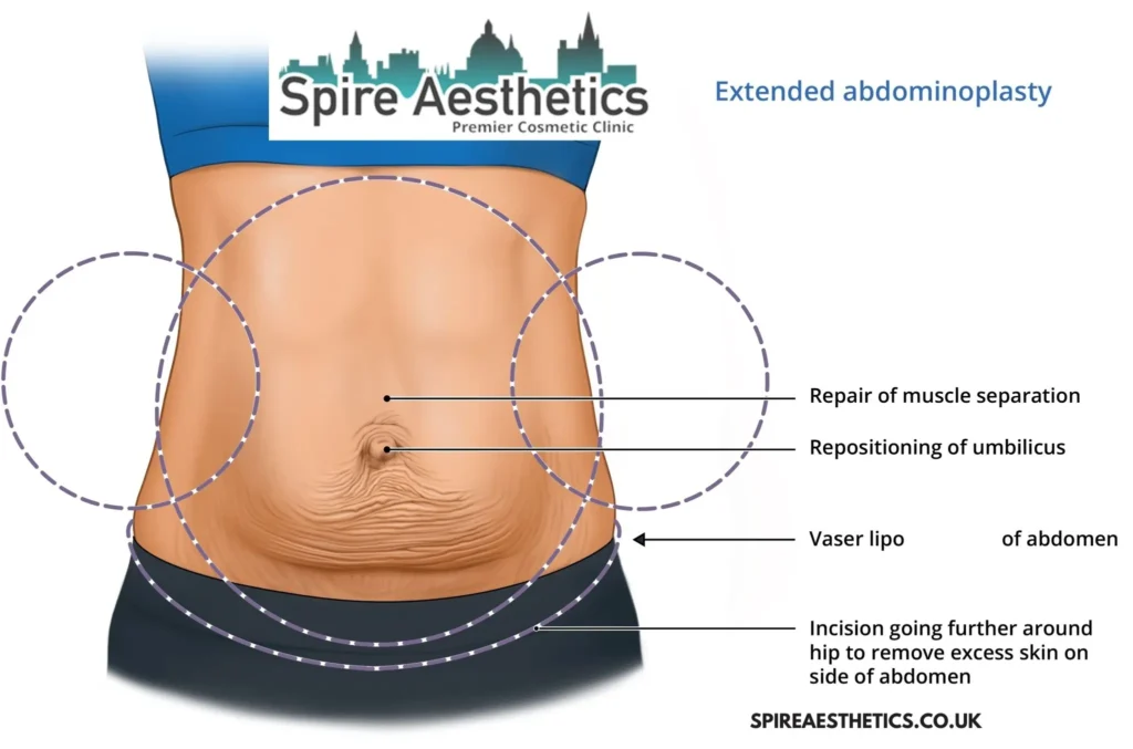 Understanding Loose Skin After Gastric Band Rochford Surgery and HIFU Treatment