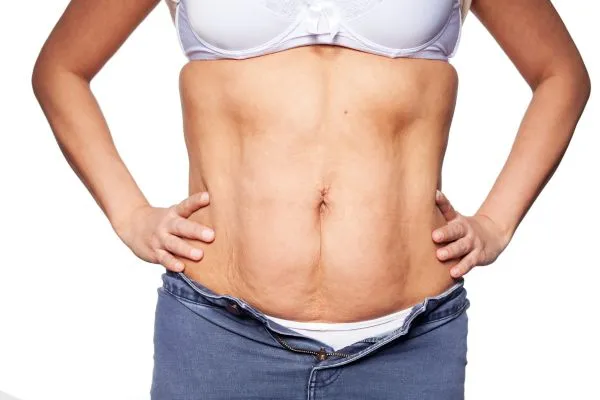 sagging skin on woman's stomach after weight loss injections Rochford