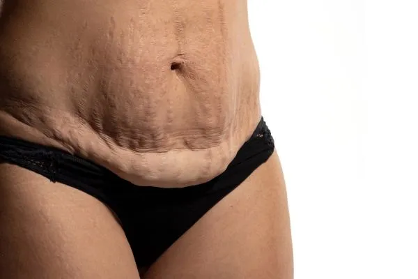 Image of womans stomach after weight loss injections Rochford showing saggy skin