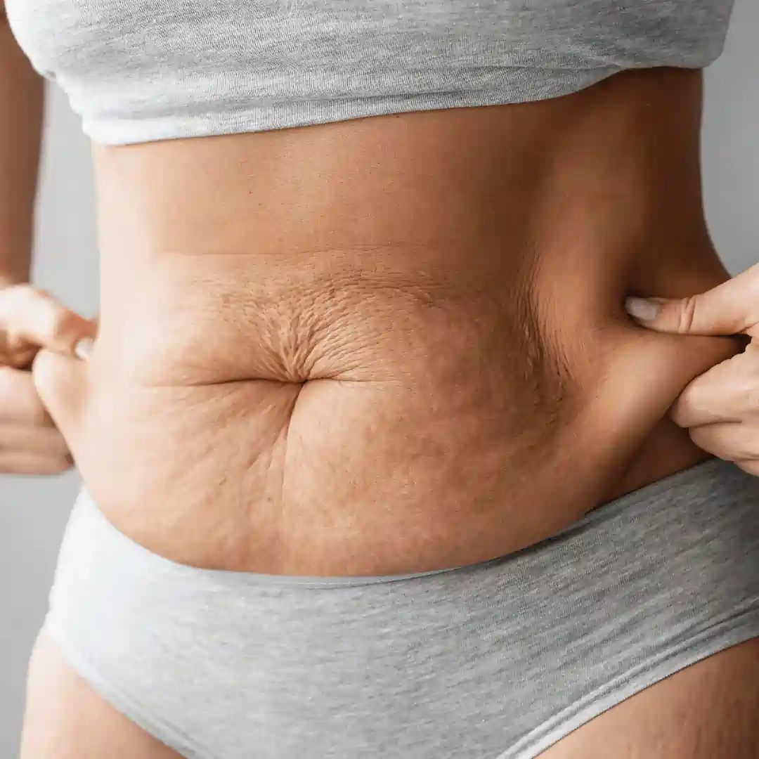Is It Normal to Have Loose Skin After Pregnancy Rochford?