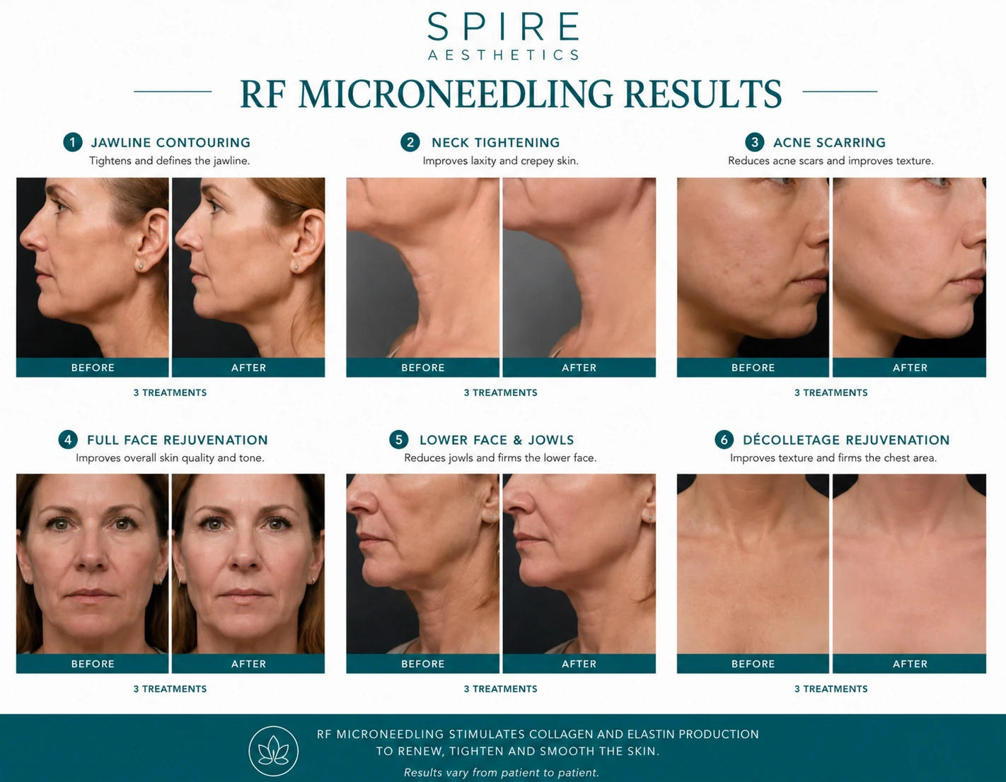 RF Microneedling Skin tightening Rochford results