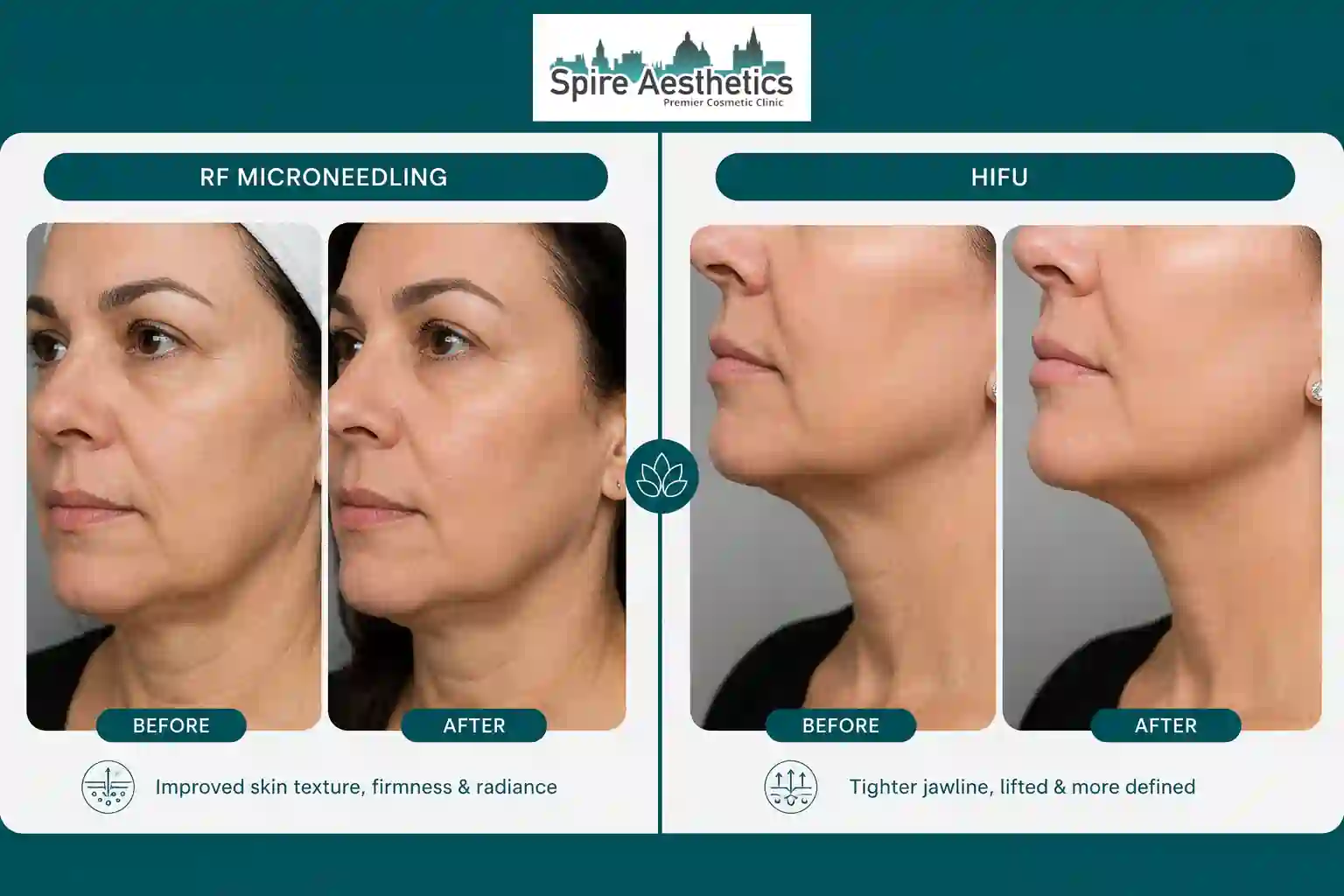 Can RF Microneedling and HIFU Be Combined Rochford?