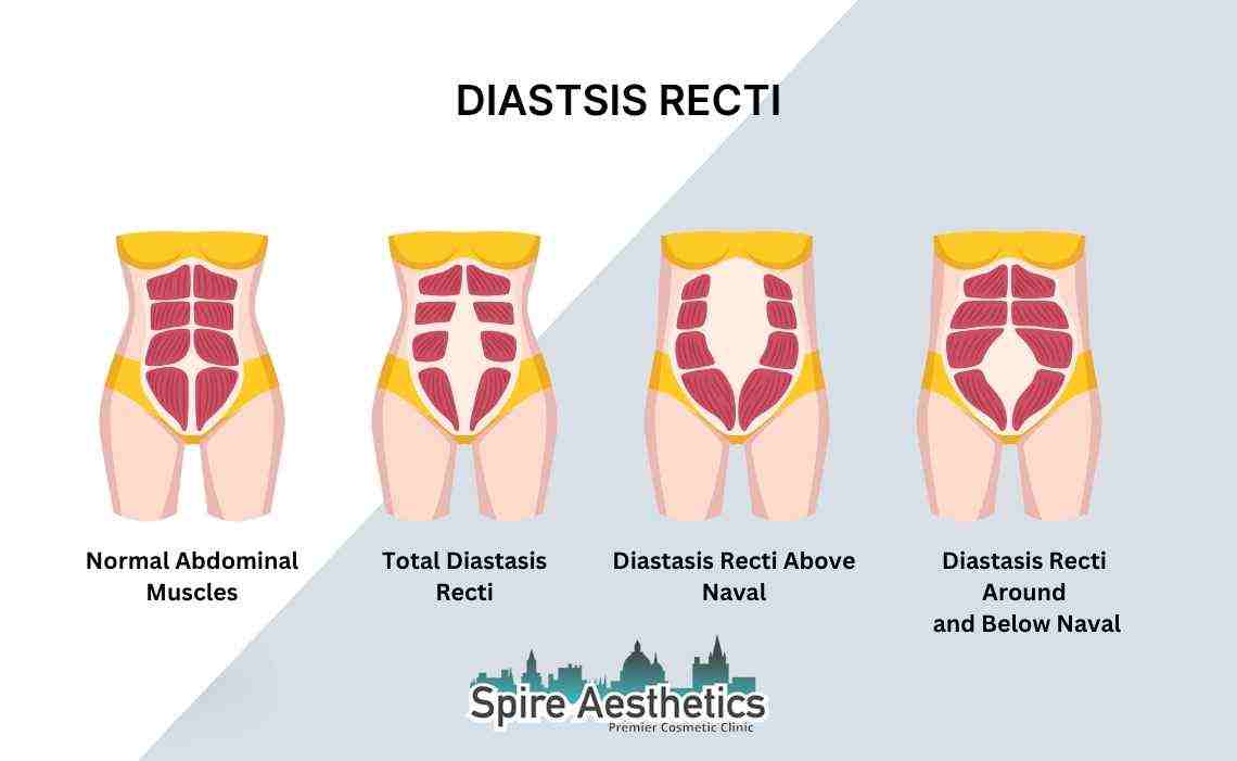 Is Non-Surgical Diastasis Recti Treatment Right for You? Common Concerns Answered Rochford